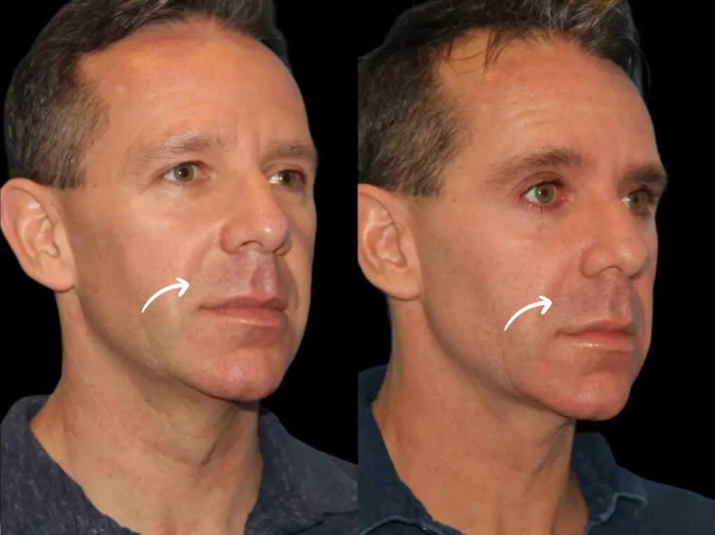 sculptra in dubai
